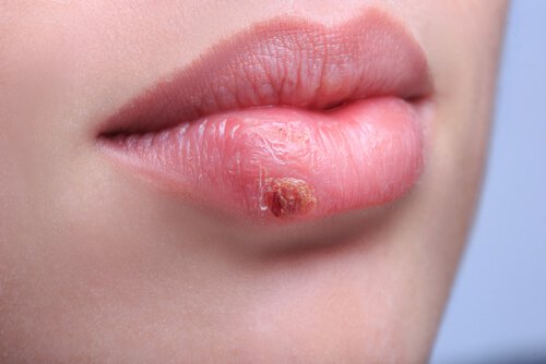 por-que-el-herpes-labial-siempre-se-repite